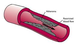 Confirmed Again: Statin Drugs Accelerate Cardiovascular Disease