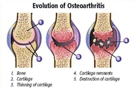 Osteoarthritis